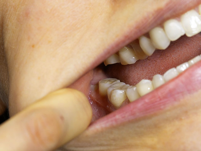 親知らずの抜歯、口腔がん検診の重要性